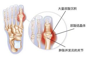 发病原理.jpg